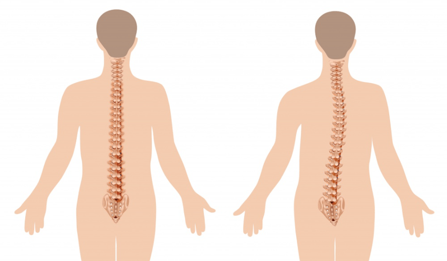 manifestación de osteocondrosis