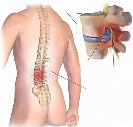 Hernia intervertebral